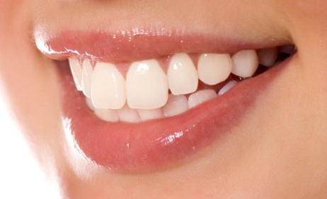 美容冠矫正牙齿一般需要多少钱？