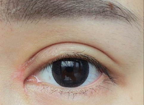 全切双眼皮消肿的方法有哪些？