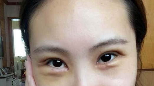 全切双眼皮副作用有哪些？
