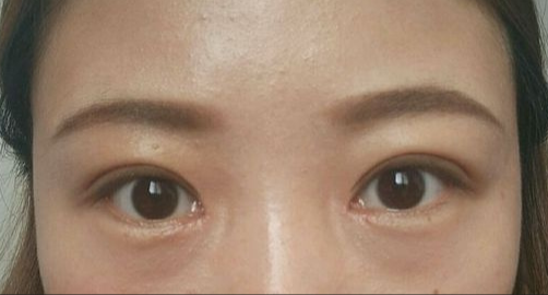 全切双眼皮能保持多久？全切双眼皮的危害有哪些？