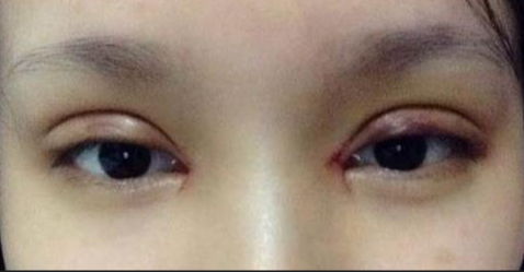 全切双眼皮一般多久才能消肿？