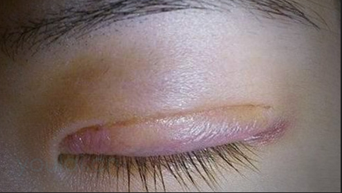 埋线双眼皮一般会肿几天？