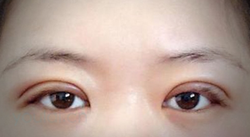 定点双眼皮需要多长时间？