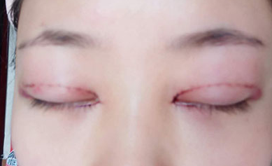 韩式开眼角手术有哪些优势？开眼角手术有哪些优势？