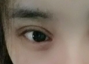 韩式开眼角手术安全吗？韩式开眼角手术的恢复时间？