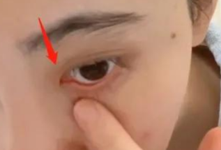 开内眼角对眼睛有伤害吗？