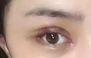 开眼角一般要恢复多久？开眼角一定会出现疤痕吗？