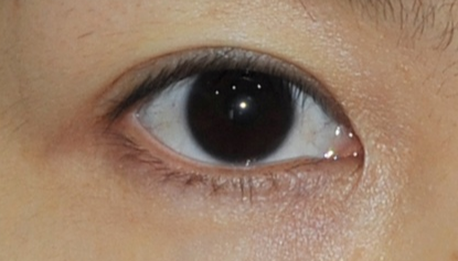 开眼角需要多长时间恢复？术后眼角发红怎么办？