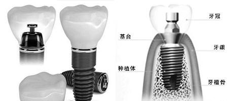 种植牙手术示意图