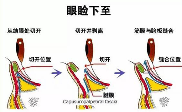 开外眼角和眼睑下至的区别是什么?多久恢复好?