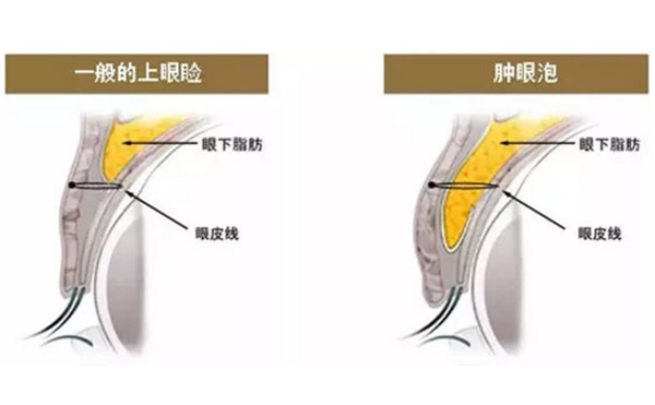 割双眼皮能改善肿眼泡吗?效果怎么样?