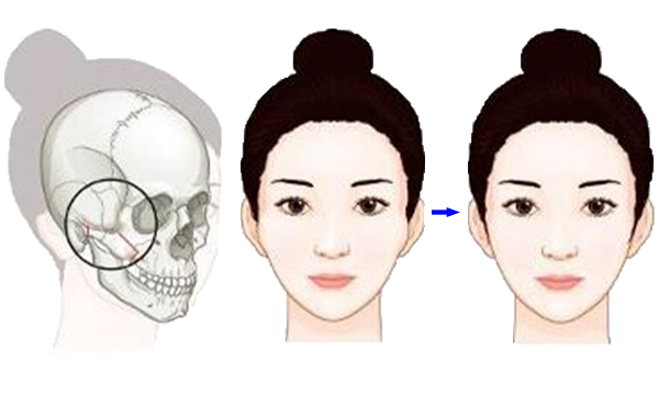 颧骨降低整形手术是怎么操作的？有什么特点？