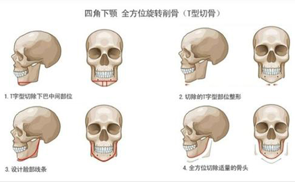 太原丽都整形专家：切下颌角手术风险主要是这六点