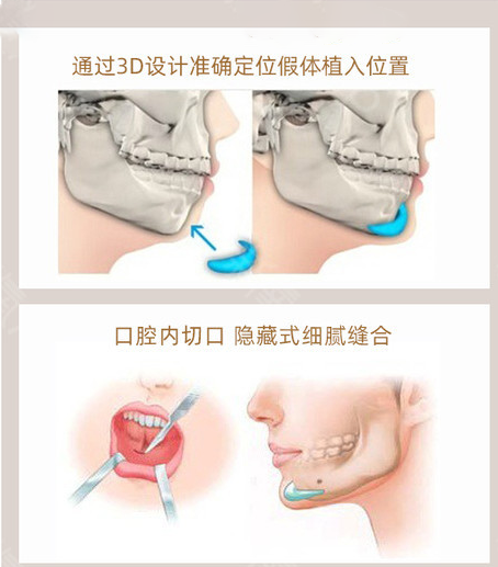 北京润美玉之光医疗美容垫下巴示意图