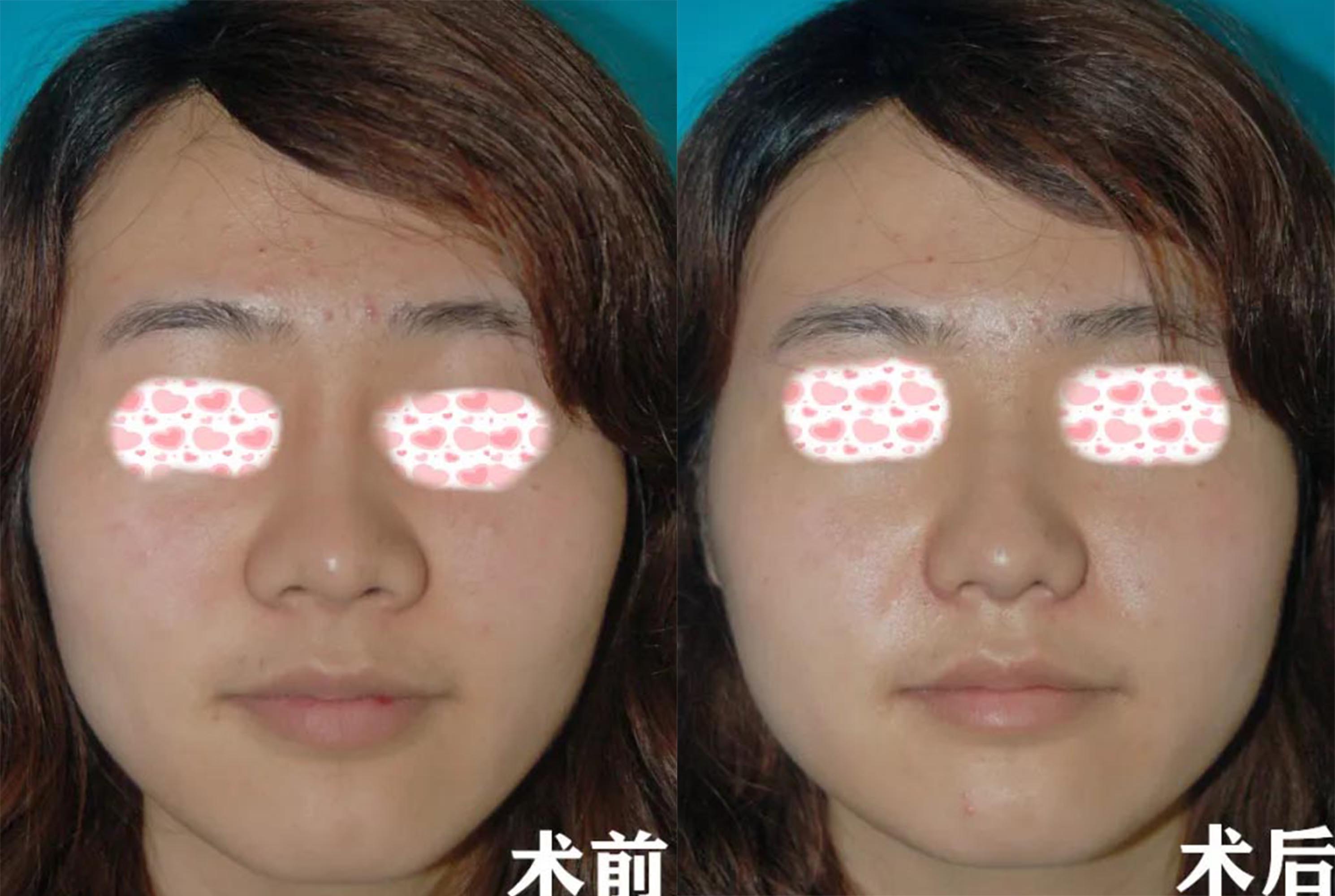 北京玉之光做鼻头缩小术前术后效果对比