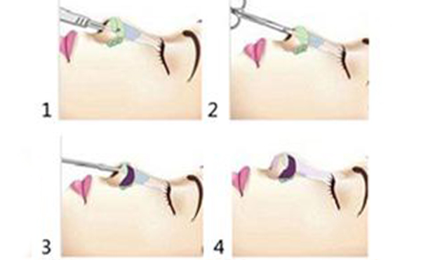 鼻小柱延长手术是怎么做的?有哪些方法?
