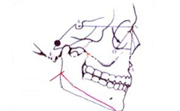 沈阳伊美尔整形：下颌角肥大矫正就是这么简单