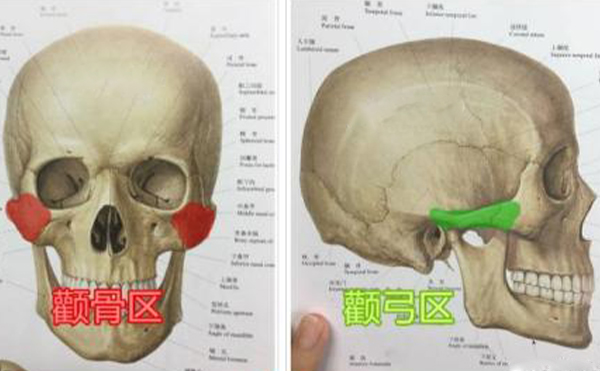 颧骨整形手术多久能消肿？