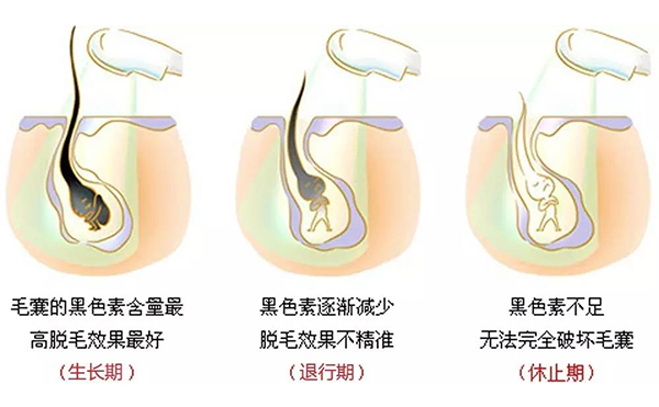 冰点脱毛