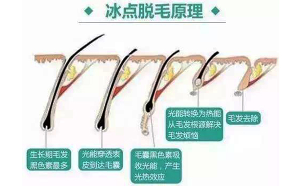 脱毛方法有哪些?都有什么区别?