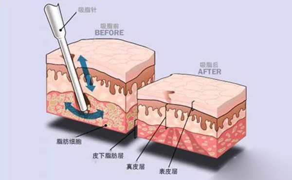 吸脂和溶脂有什么区别?哪个效果好?