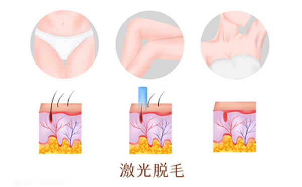 脱毛方法有哪些?都有什么区别?