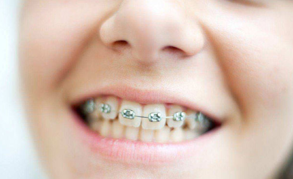 儿童牙齿矫正的最佳年龄是多少？