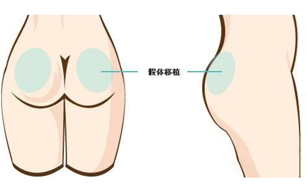 填充臀部有哪些方法?疤痕体质可以做丰臀吗?