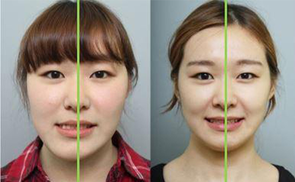 面部不对称是什么原因造成的?怎么矫正?