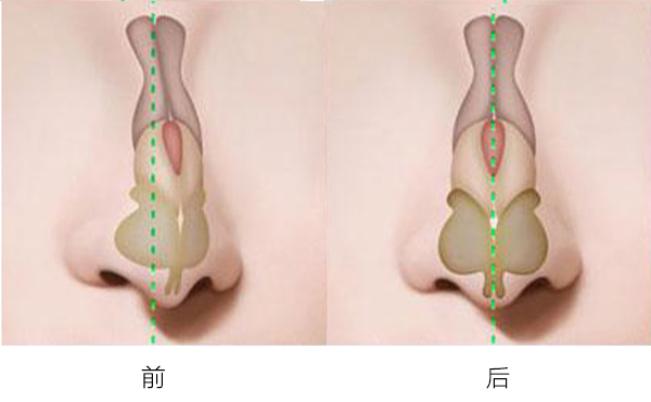 歪鼻整形可以改善什么类型的歪鼻?哪些情况下不允许做歪鼻矫正?