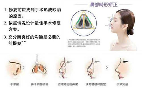 隆鼻修复效果怎么样？