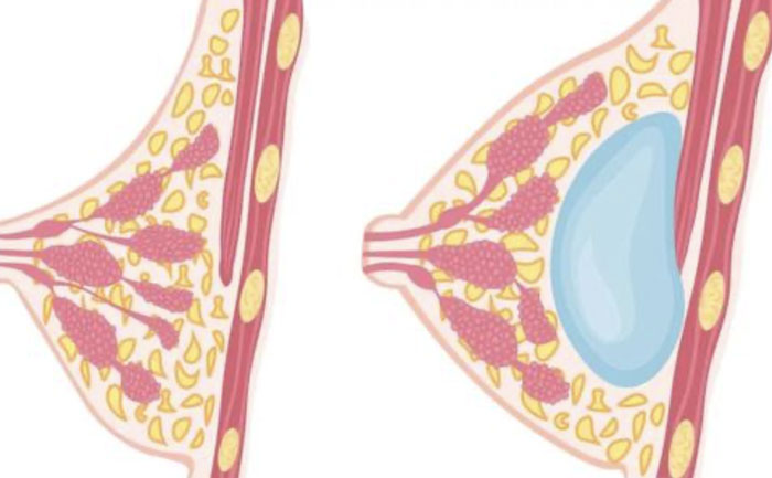 硅胶假体丰胸需要多少钱？硅胶假体丰胸可以保持多久？
