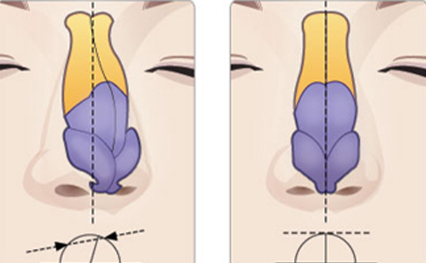 常见的歪鼻矫正方法有哪些?