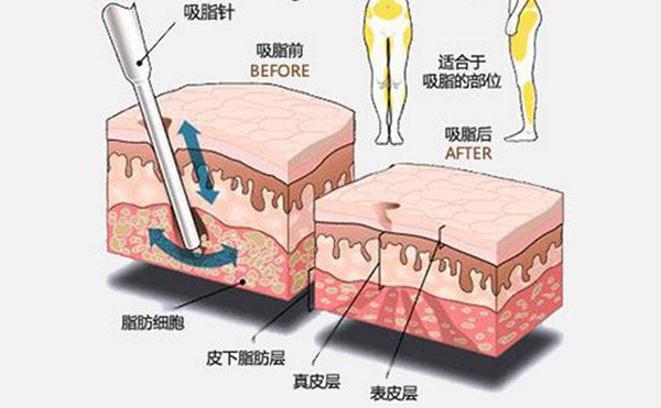 大腿吸脂有什么优点？