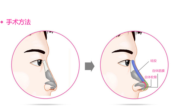 假体隆鼻的优点