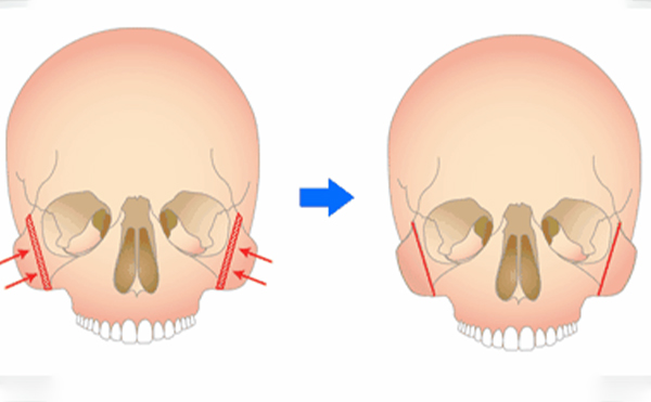 颧骨整形手术安不安全？有危险吗？