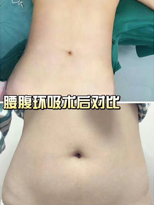 腰腹环吸术效果对比图1