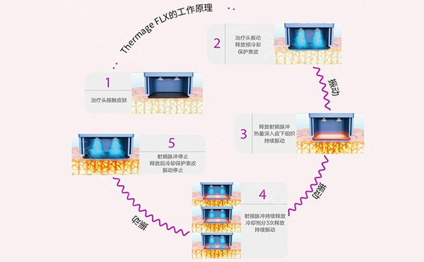 电波拉皮怎么去除鱼尾纹？