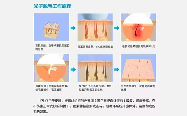 脱毛方法有哪些?都有什么区别?