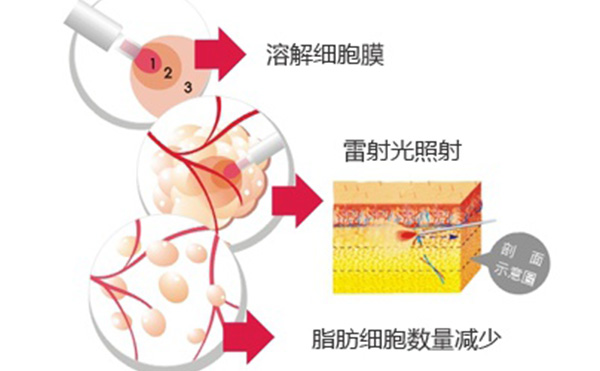 吸脂和溶脂有什么区别?哪个效果好?