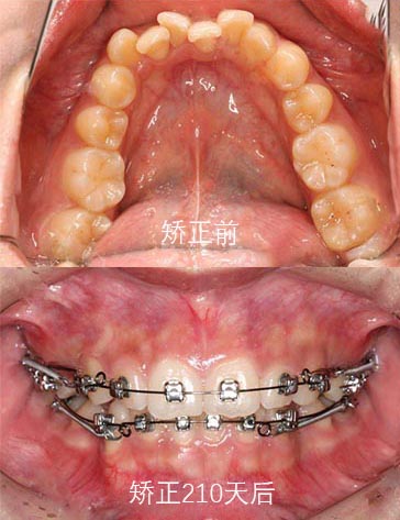 牙齿矫正
