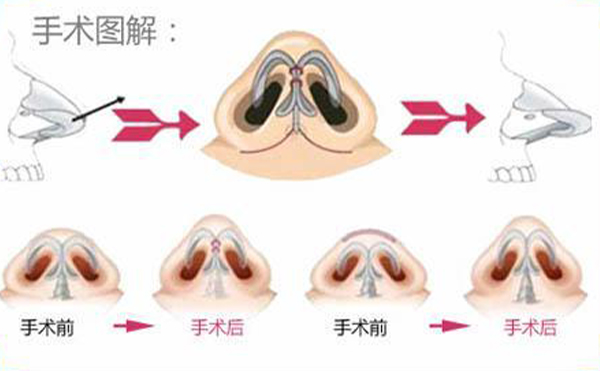 鼻翼缩小手术过程