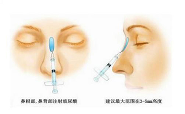 注射隆鼻的优点