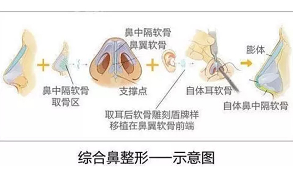 鼻综合整形的效果怎么样？鼻综合手术安全吗？