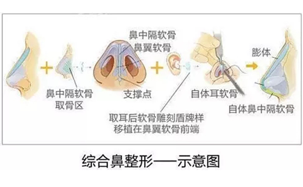 为什么都建议做鼻综合手术？