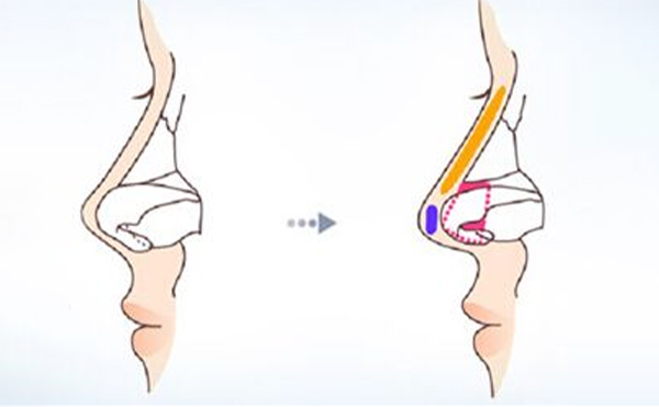 鼻小柱在什么情况下会影响美观?鼻小柱的各种畸形是如何矫正的