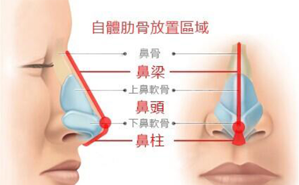 做个肋骨鼻子一般需要多少钱?全肋好还是半肋好?