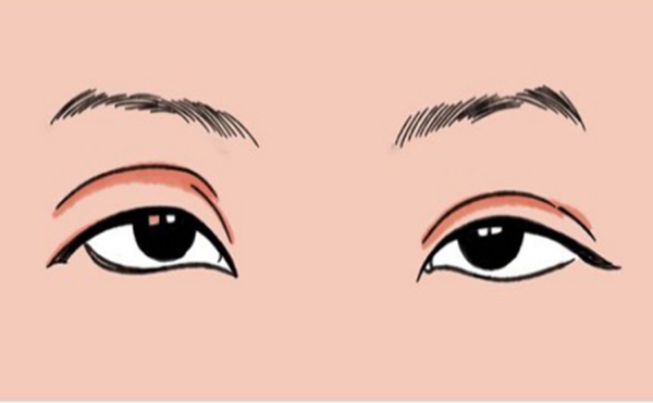 眼皮松弛下垂是什么原因?眼皮下垂提眉能解决吗?