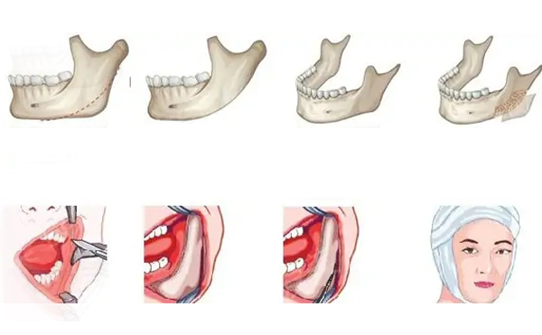 下颌角手术是在哪里切口?有几种切口方式?
