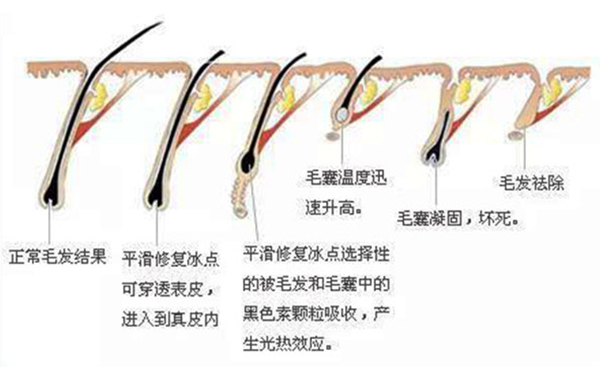 面部冰点脱毛会反弹吗?不到半年又长了是怎么回事?